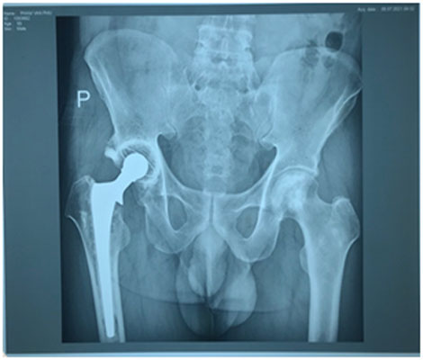 Thay lại khớp háng  ( Revision of hip Arthroplasty )